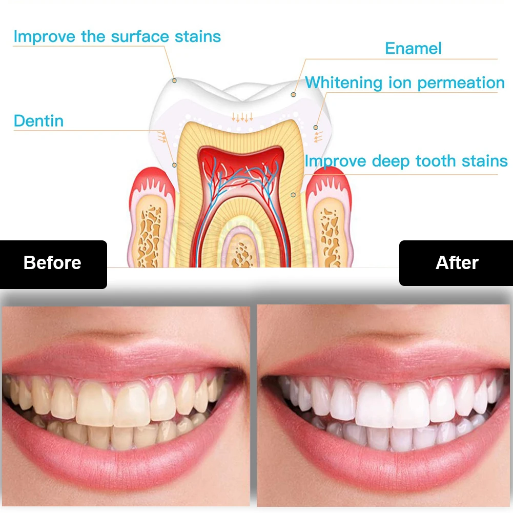 Набор для отбеливания зубов, м – обзор и цена Teeth Whitening That Works